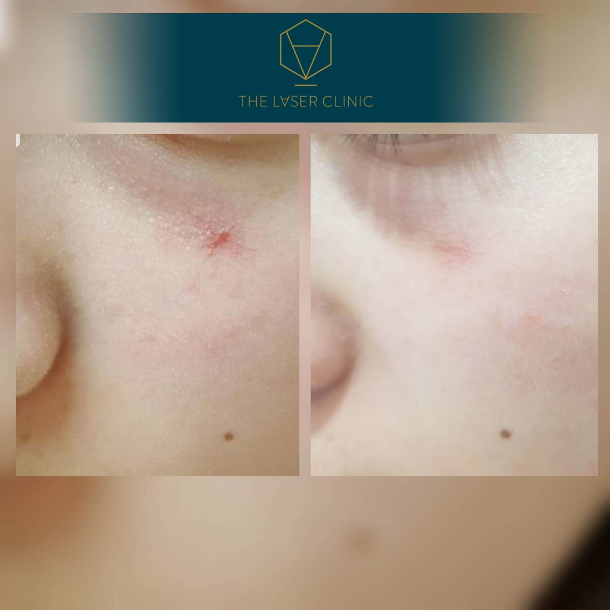 Pigmented Lesions - The Laser Clinic Exmouth