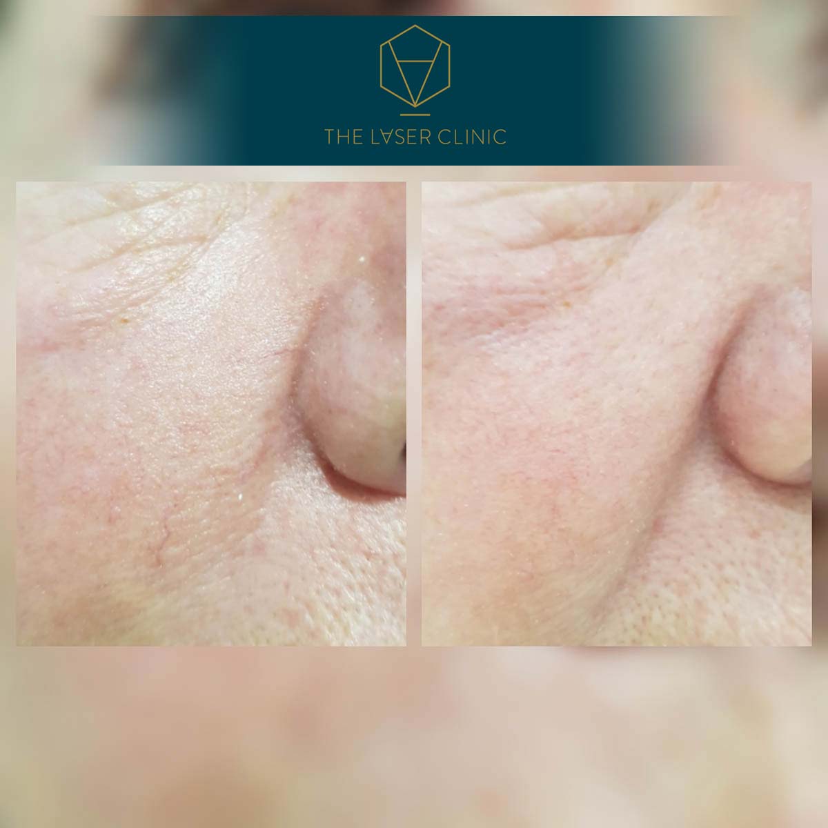 Thread Vein 2 - The Laser Clinic Exmouth
